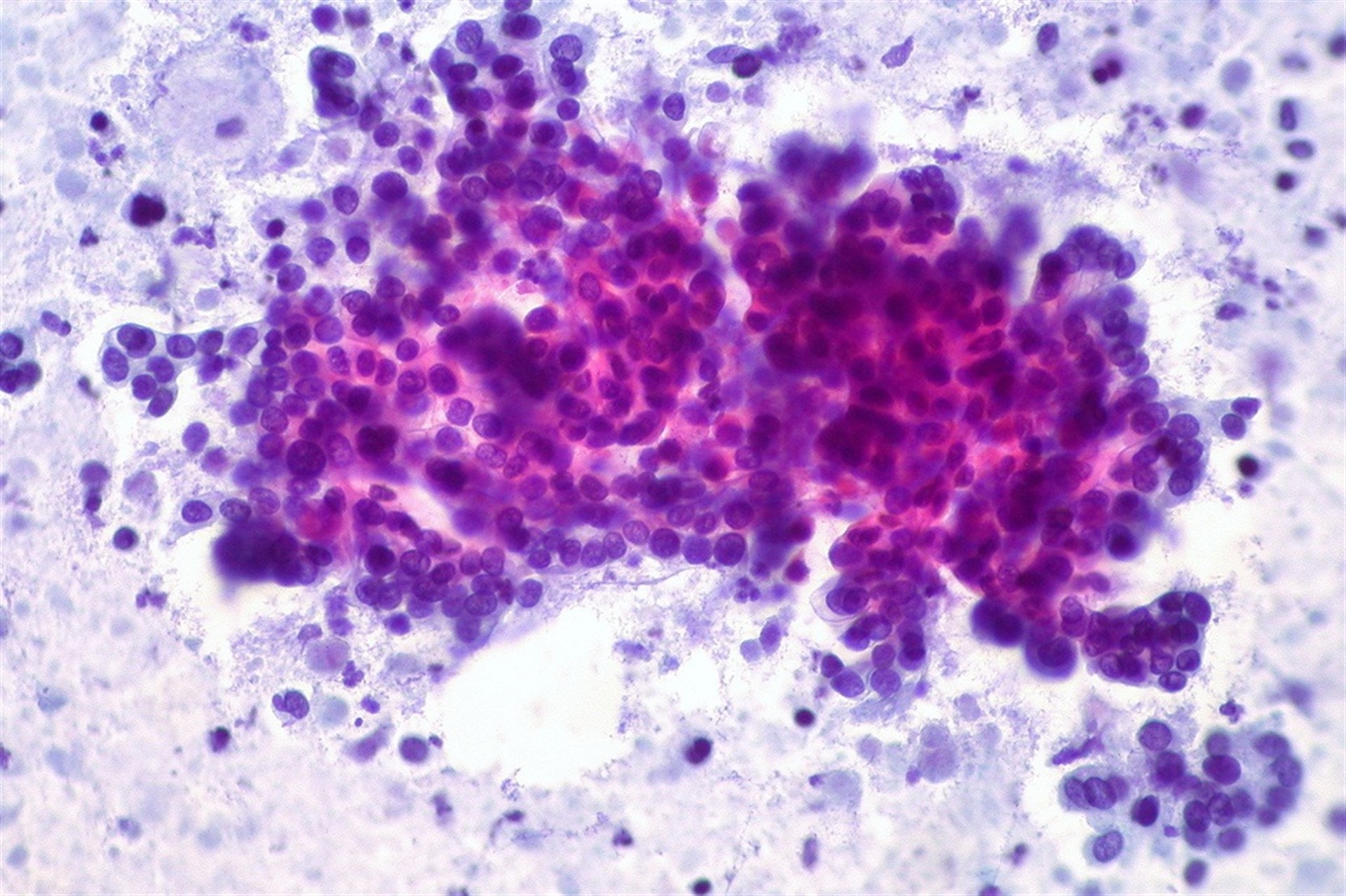 Descubren el origen de la capa celular que ‘oculta’ el cáncer de estómago